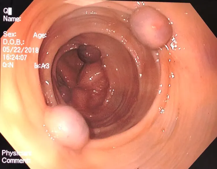 Bovine Colon Polypectomy Specimen