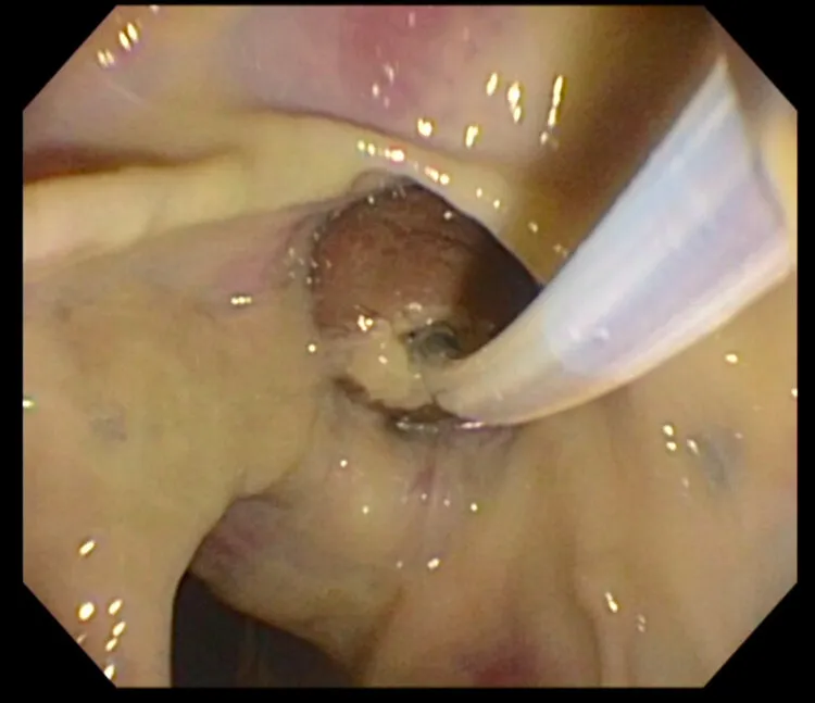 ERCP Cartdrige Model