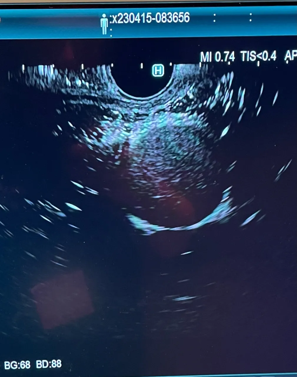 EUS Pseudocyst Specimen