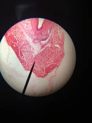 Slides-Oesophagus, Esophagus Lower third