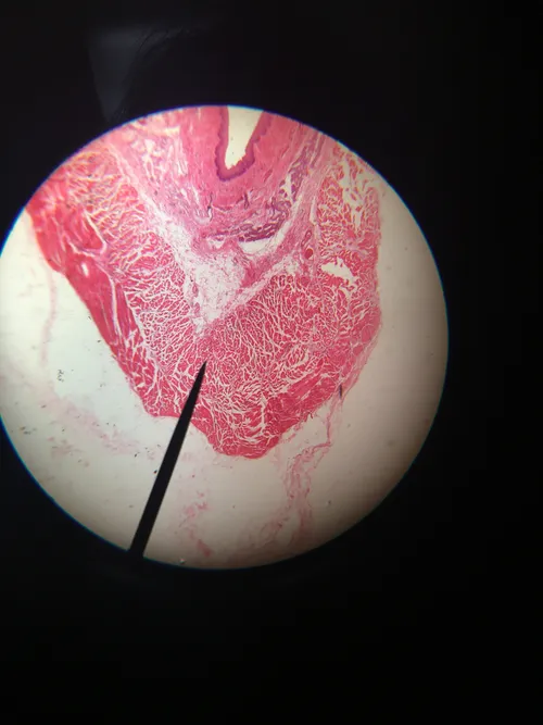 Slides-Oesophagus, Esophagus Lower third