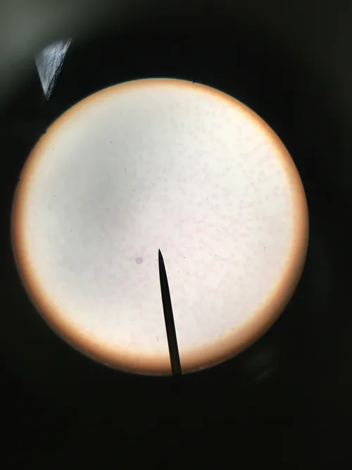 Slides-Acute granulocytic leukemia